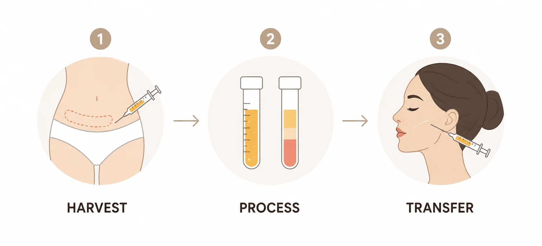 The Three Stages of Fat Transfer